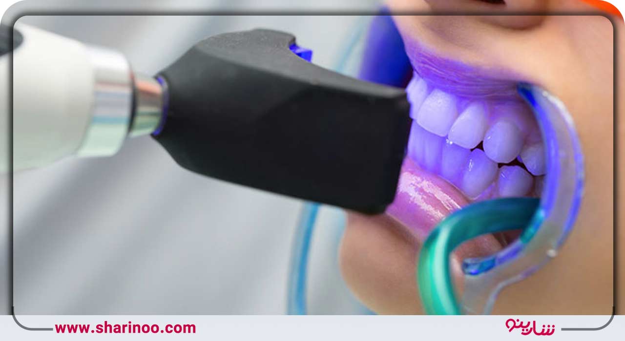 سفید کردن یا وایتینگ دندان