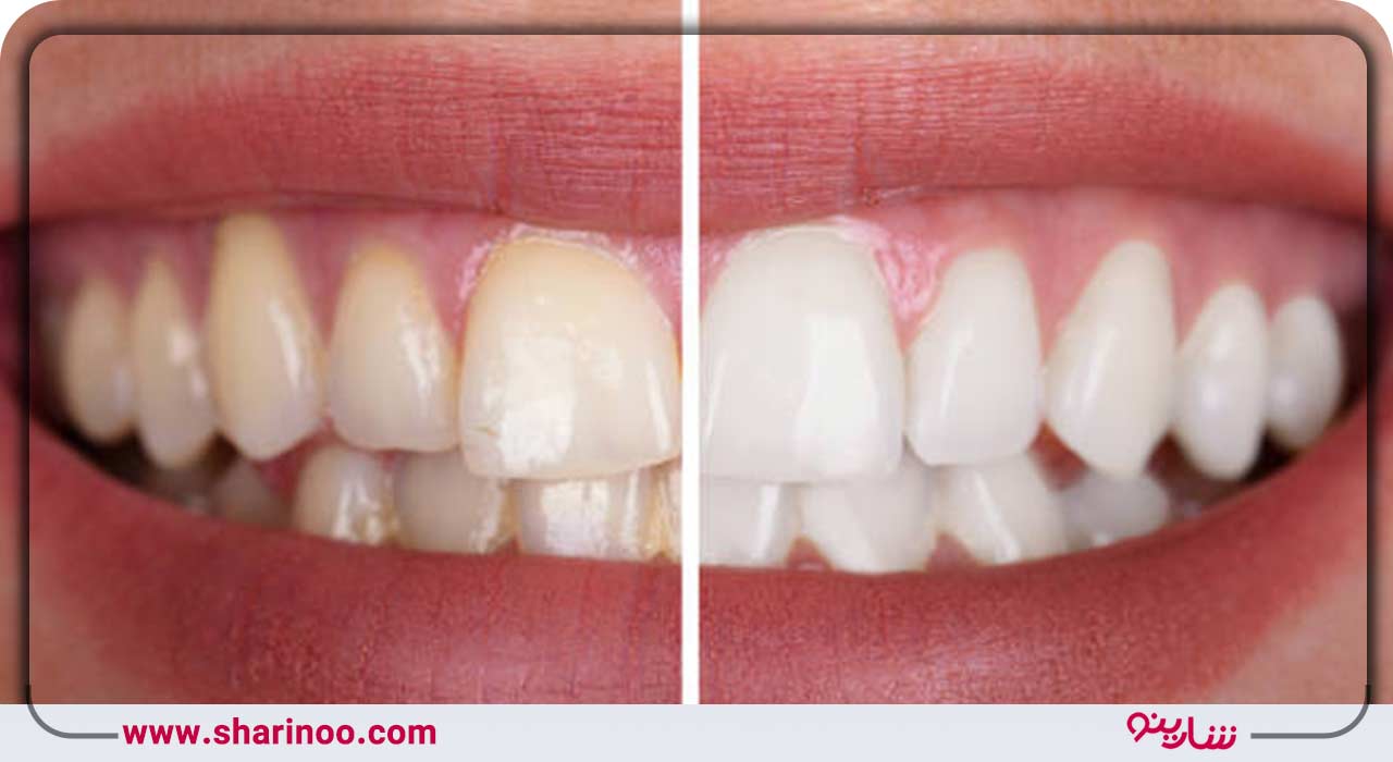 باندینگ زیبایی