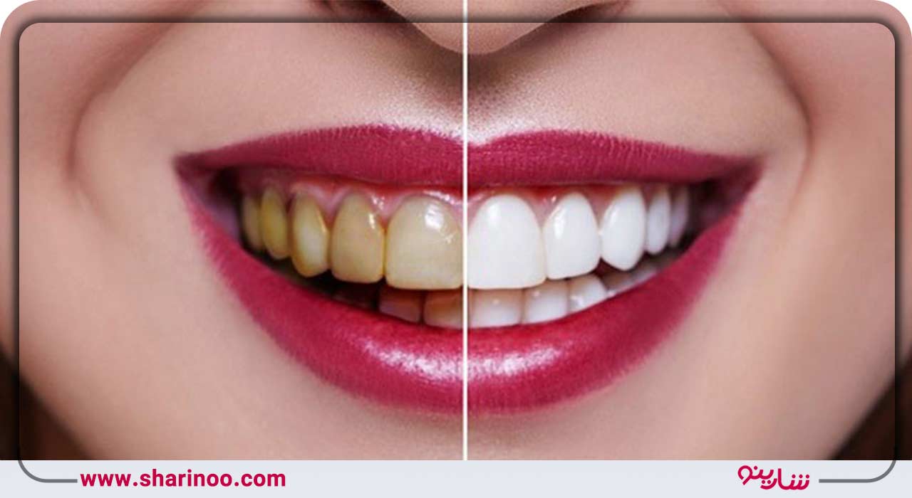 اصلاح طرح لبخند