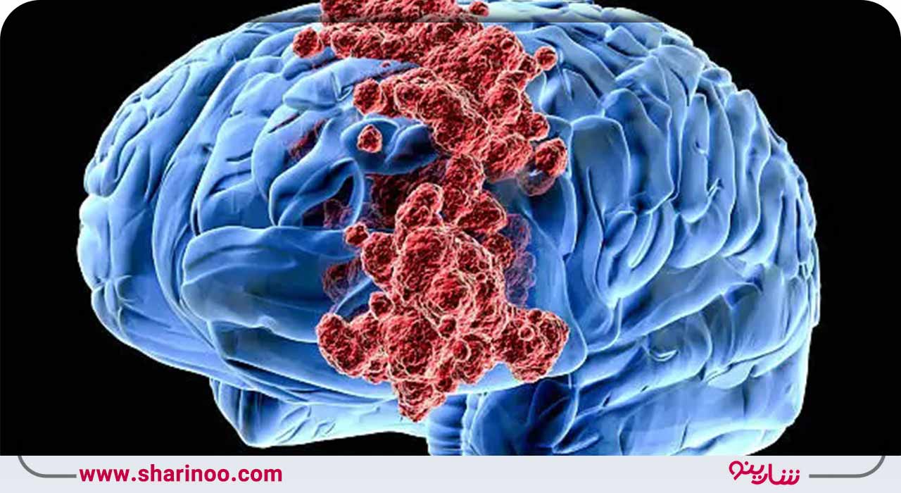 متخصصان مغز و اعصاب چه بیماری‌هایی را درمان می‌کنند؟