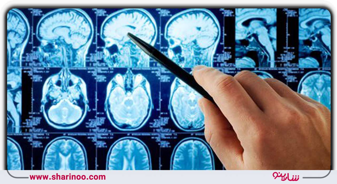اختلالات حرکتی
