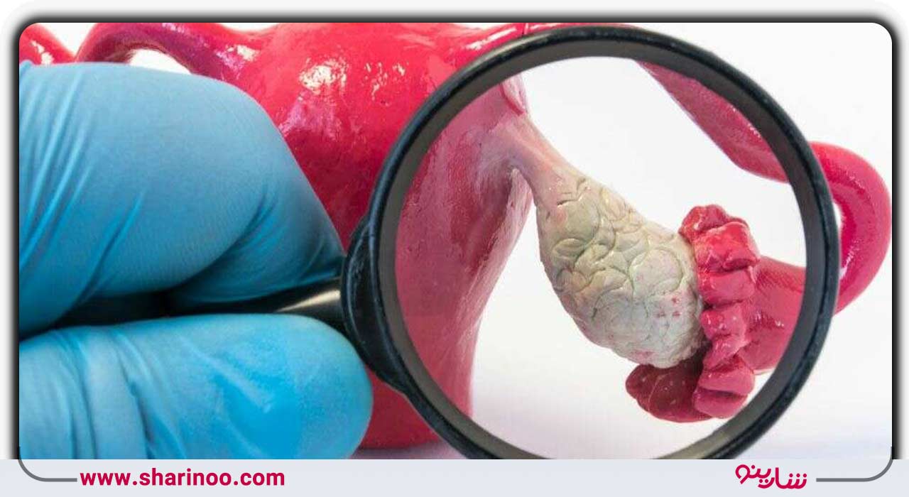 سندرم تخمدان پلی کیستیک