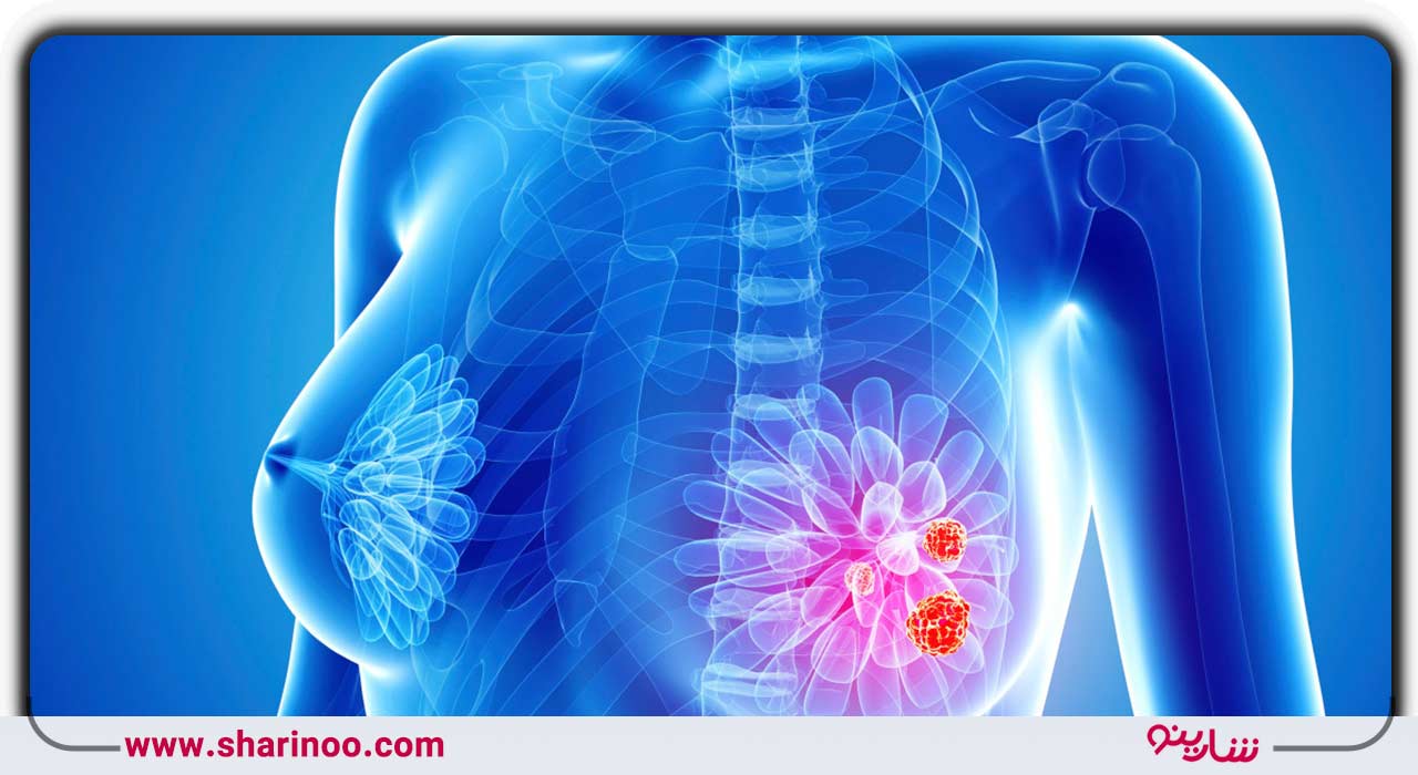 بیماری های پستان