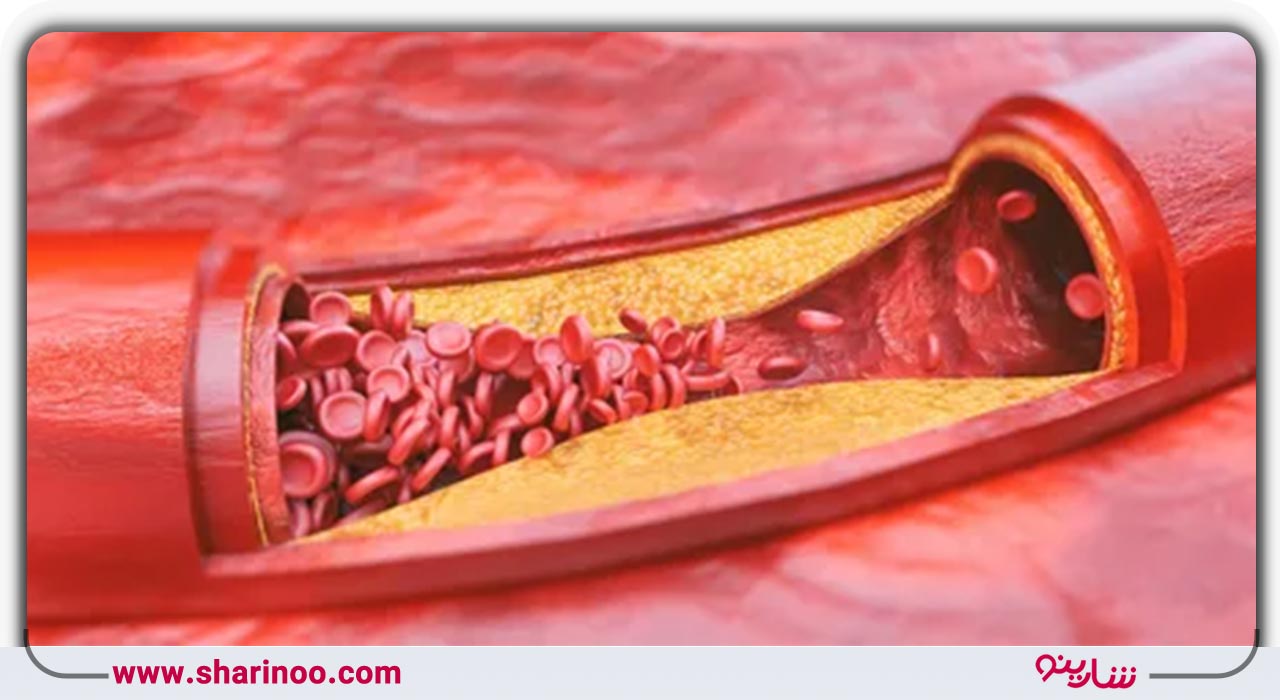 آترواسکلروز یا تصلب شریان- پزشک قلب در اصفهان