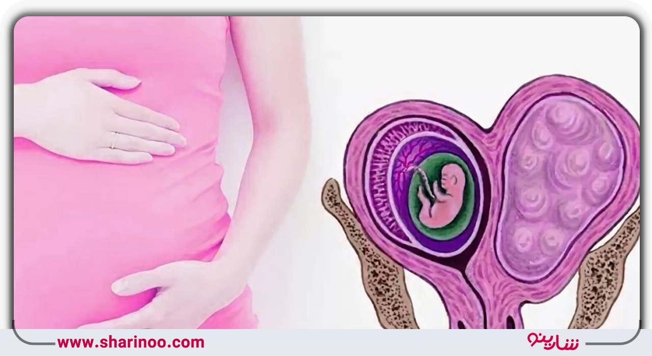 بهترین پزشکان زنان و زایمان در یزد- درمان چسبندگی رحم در یزد