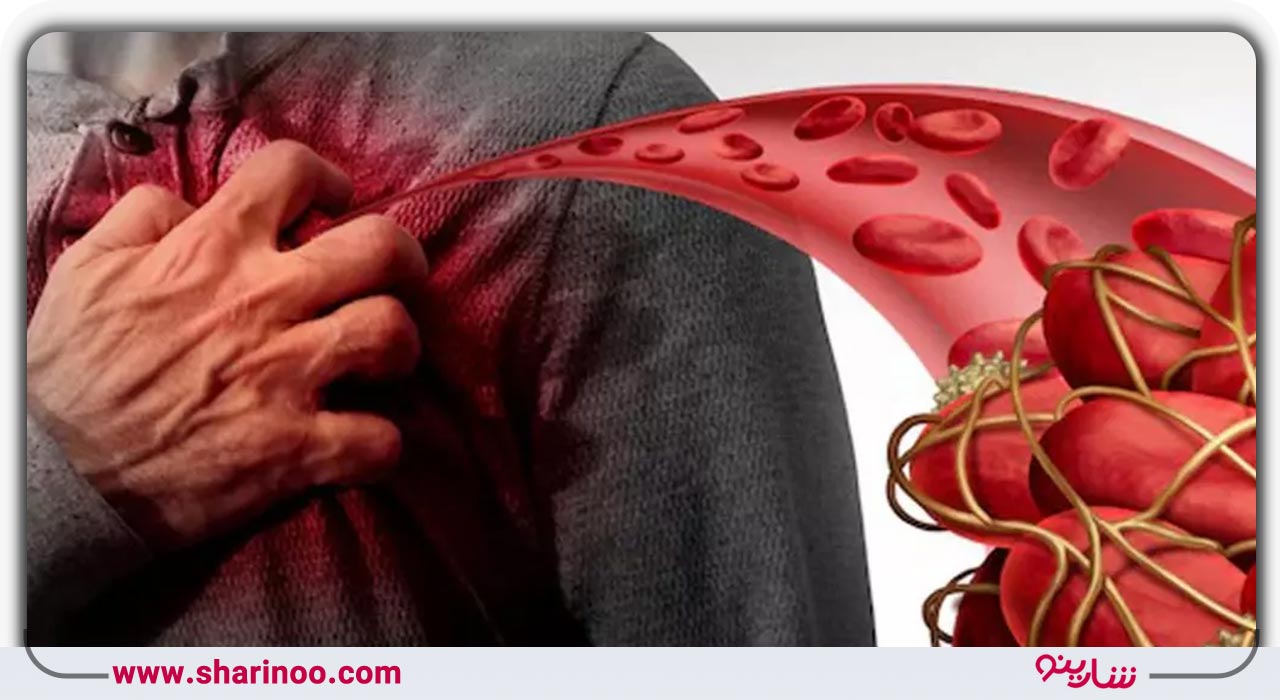 فیبریلاسیون دهلیزی (Afib)- لخته شدن خون- متخصص قلب در اصفهان