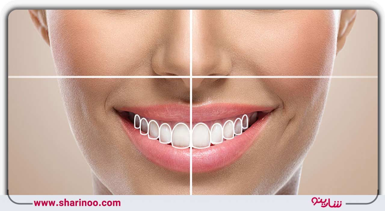 اصلاح طرح لبخند