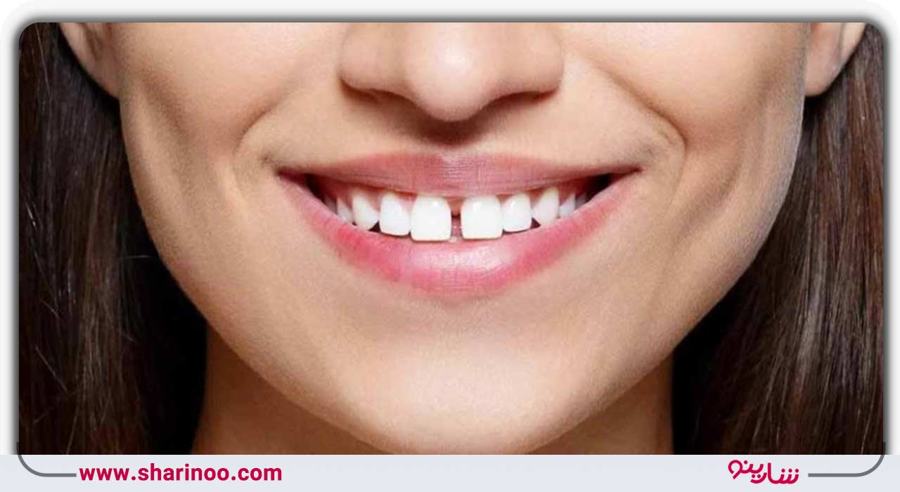 پر کردن سوراخ‌ها و شکاف‌های بین دندان‌ها