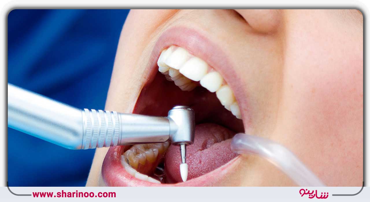 پر کردن دندان