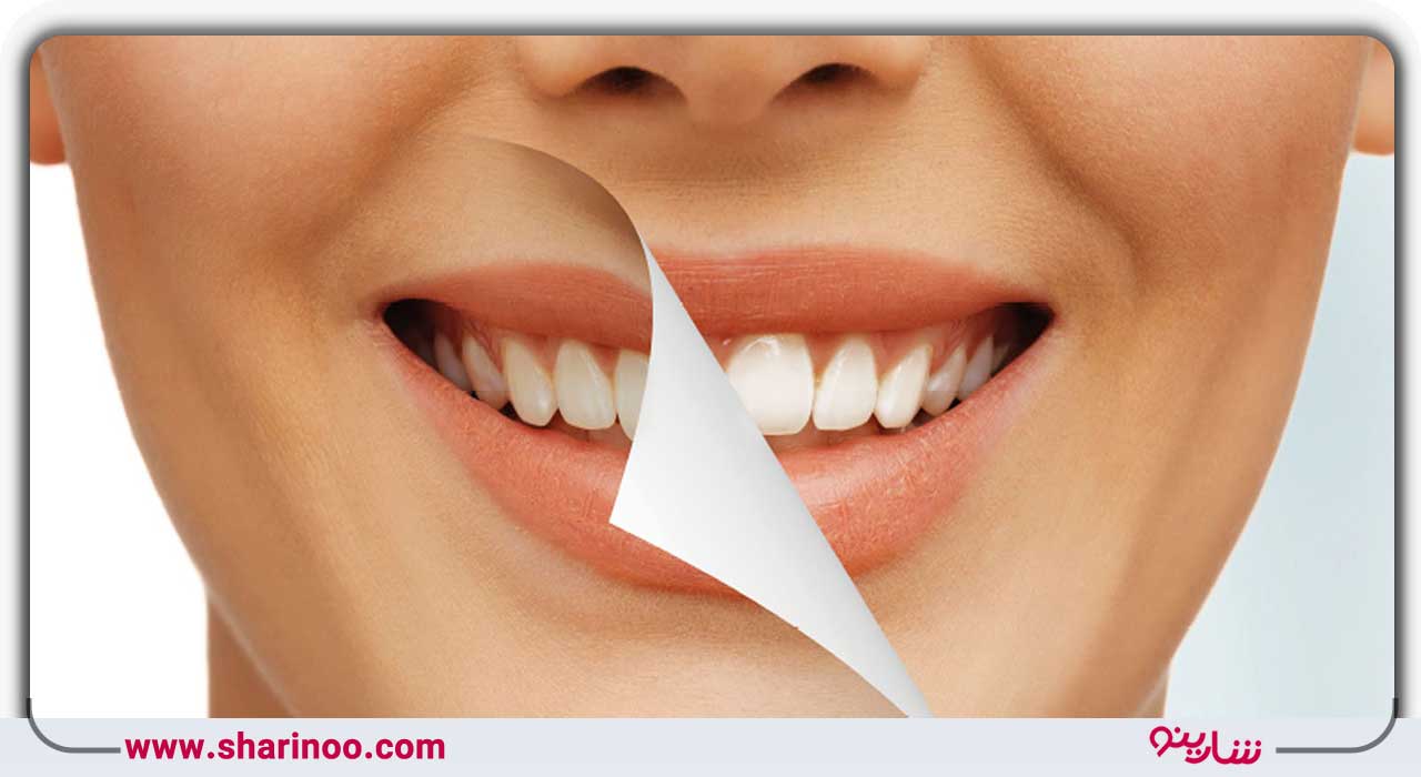 عصب کشی دندان