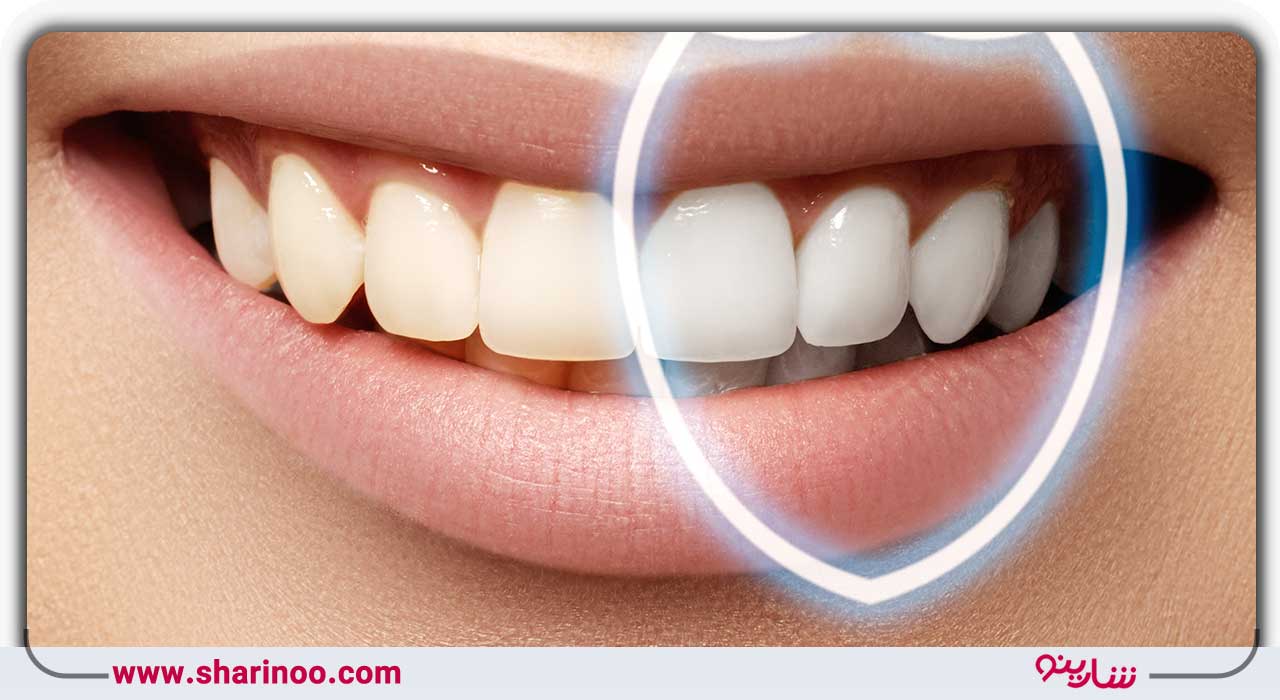 باندینگ دندان