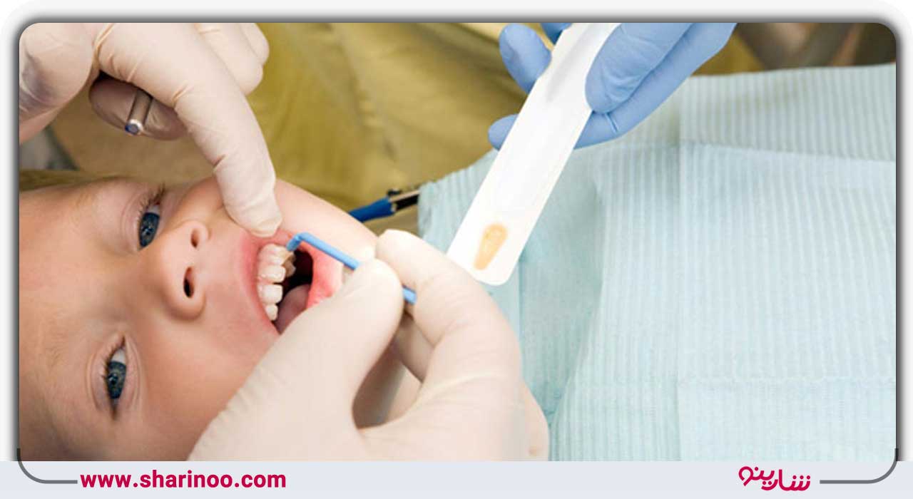 فلوراید تراپی