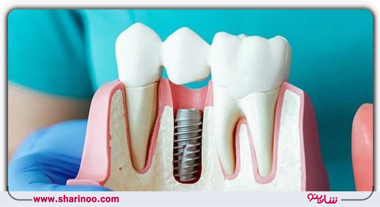 متخصص پروتزهای درمانی در اصفهان