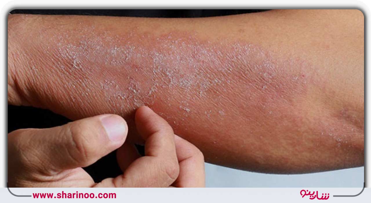 بیماری‌های پوستی ناشی از انگل، قارچ و باکتری