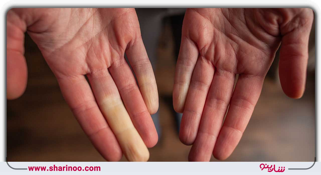 سندرم رینود