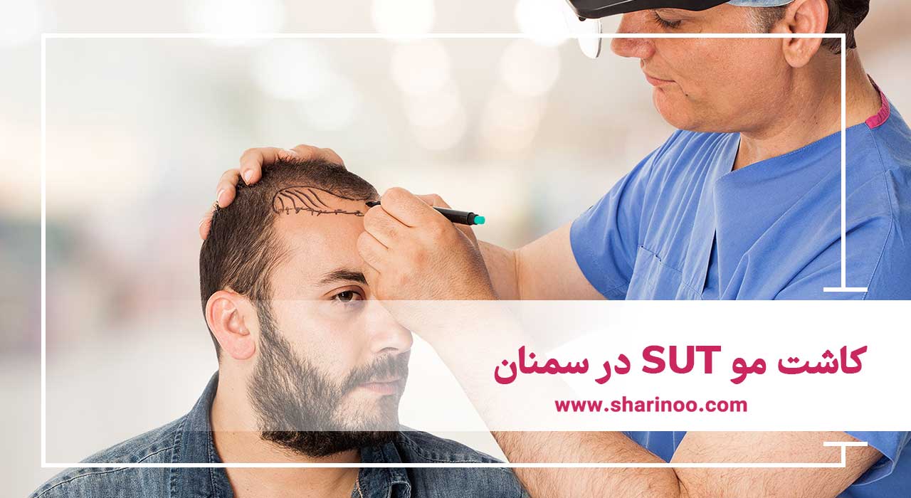 کاشت مو در سمنان