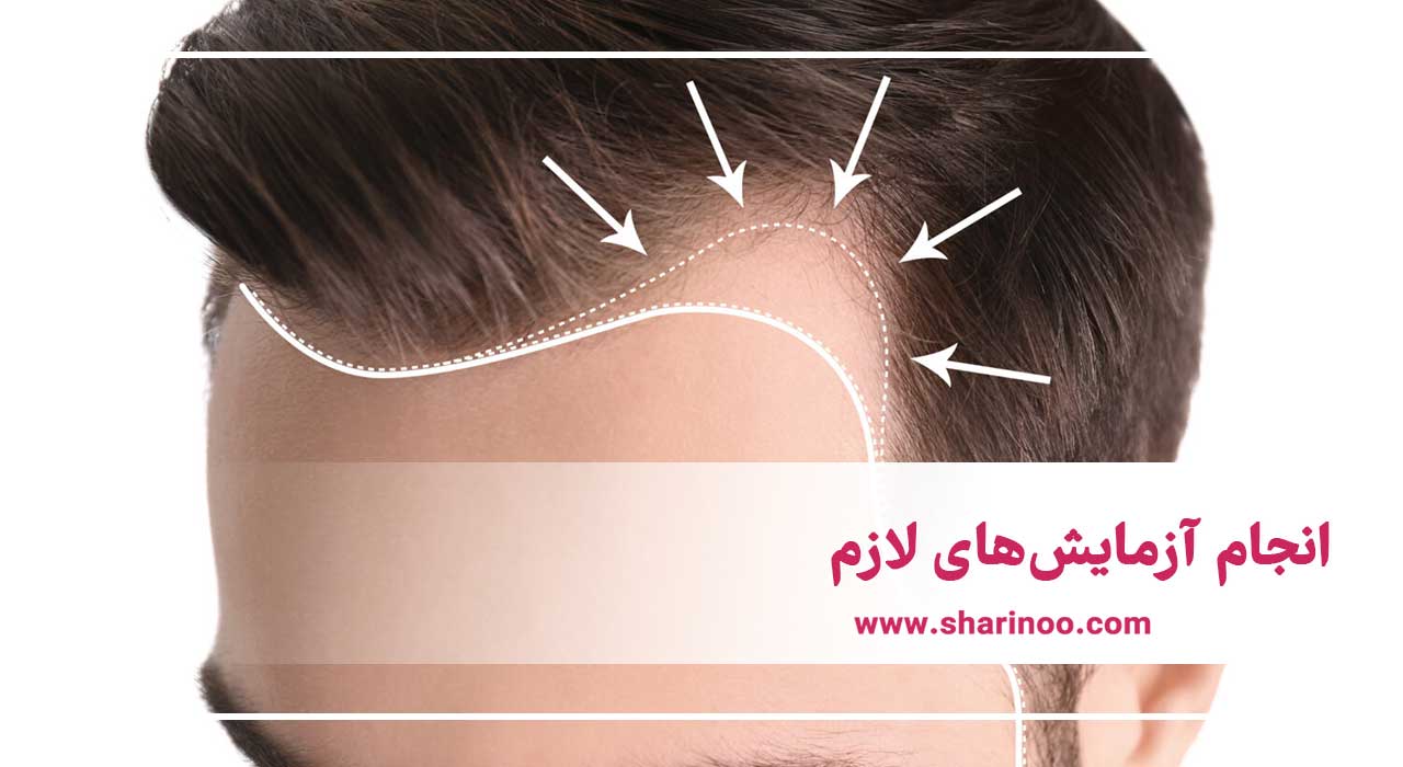 مراحل کاشت مو در سمنان