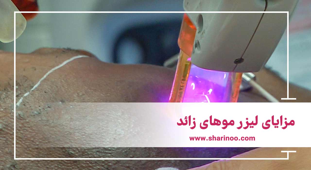 مزایای لیزر مو‌های زائد