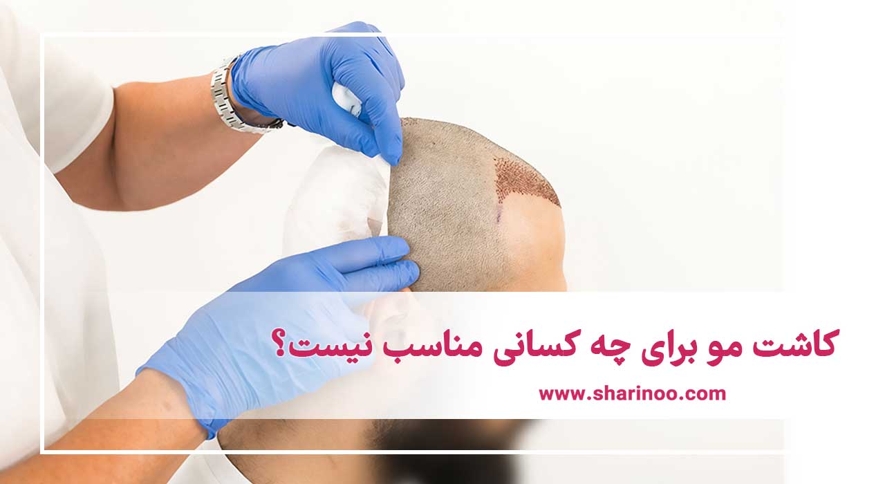 پیوند مو در سمنان