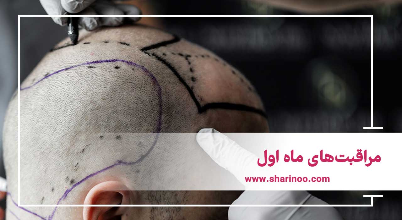 مراقبت‌های بعد از کاشت مو