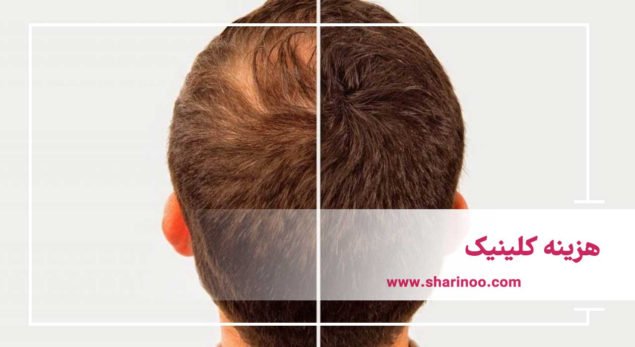 قیمت کاشت مو در سمنان