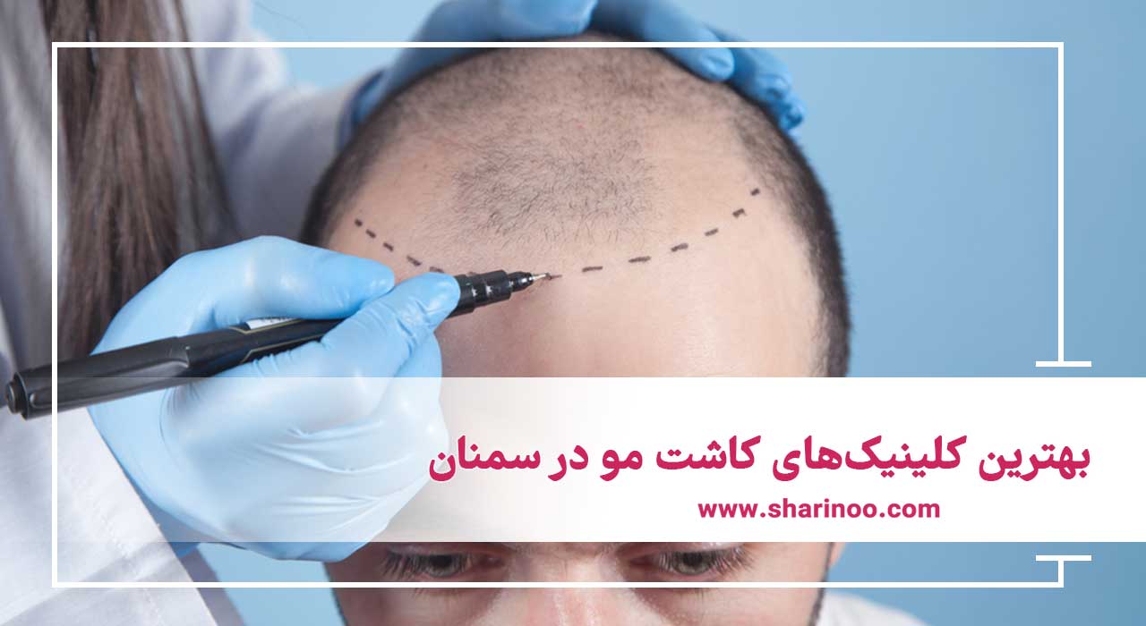بهترین کلینیک‌های کاشت مو در سمنان